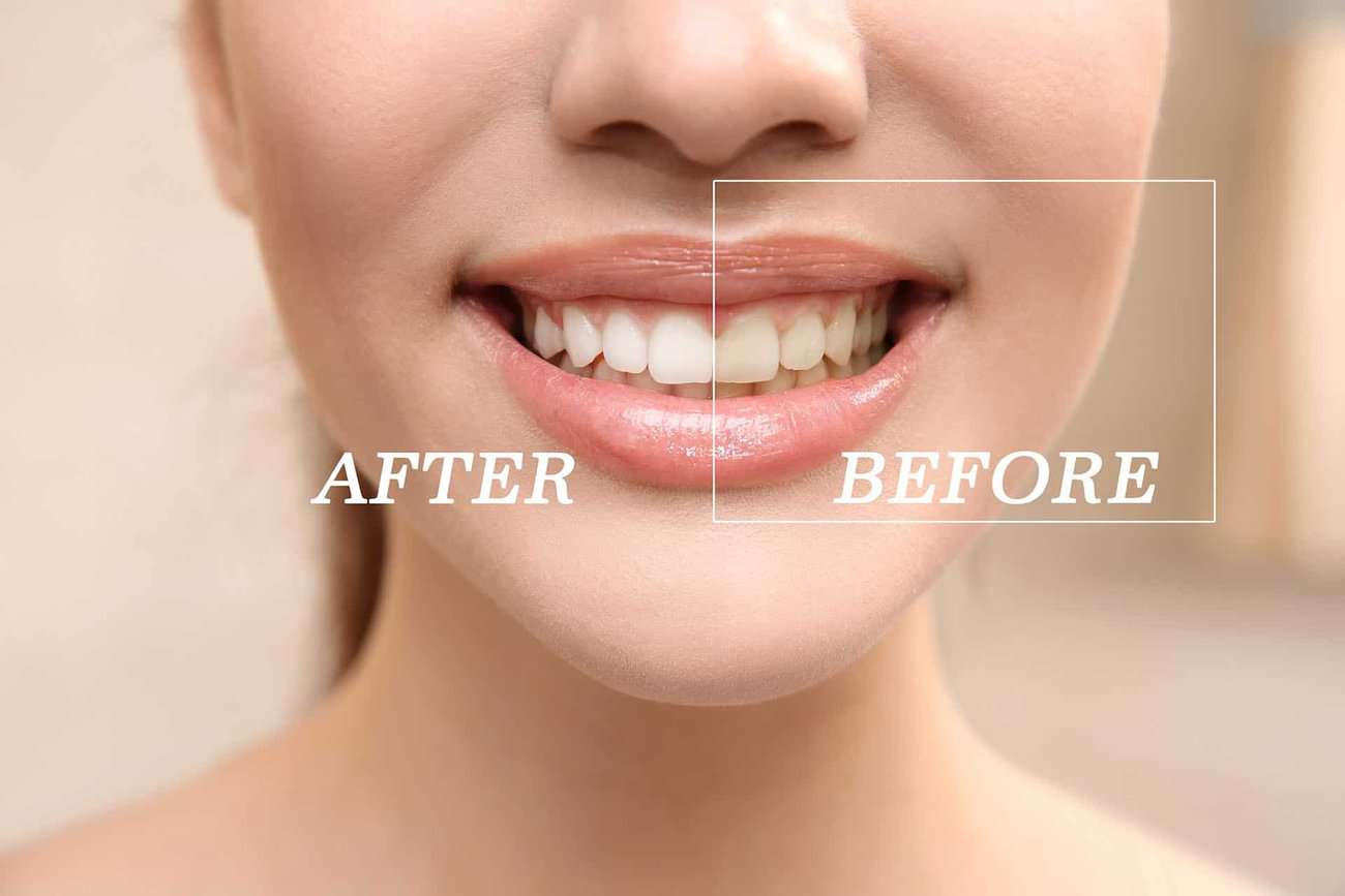 What Are the Most Effective Natural Teeth Whitening Methods You Can Try Folkestone?