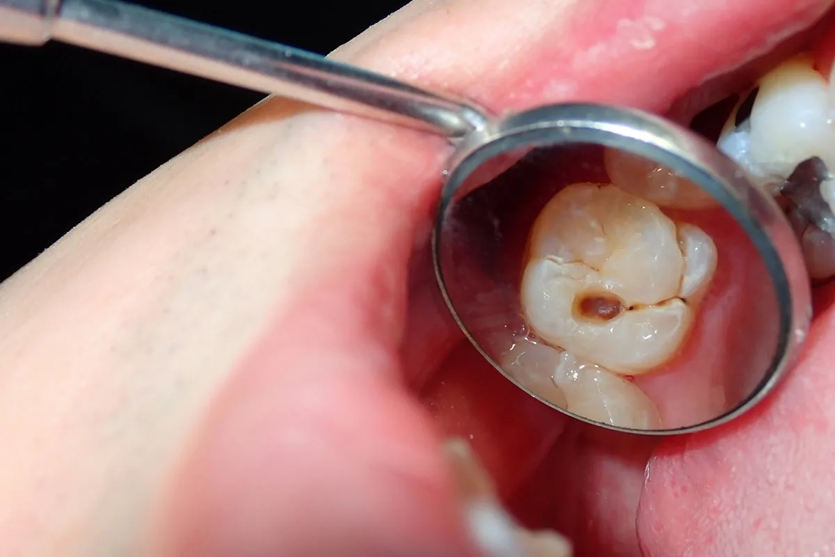 Why Do Teeth Crack? Common Causes to Know Folkestone