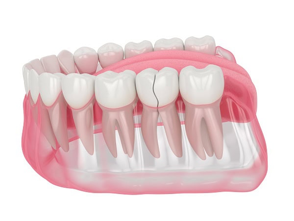 How Can You Manage Pain and Discomfort After a Root Canal Folkestone?
