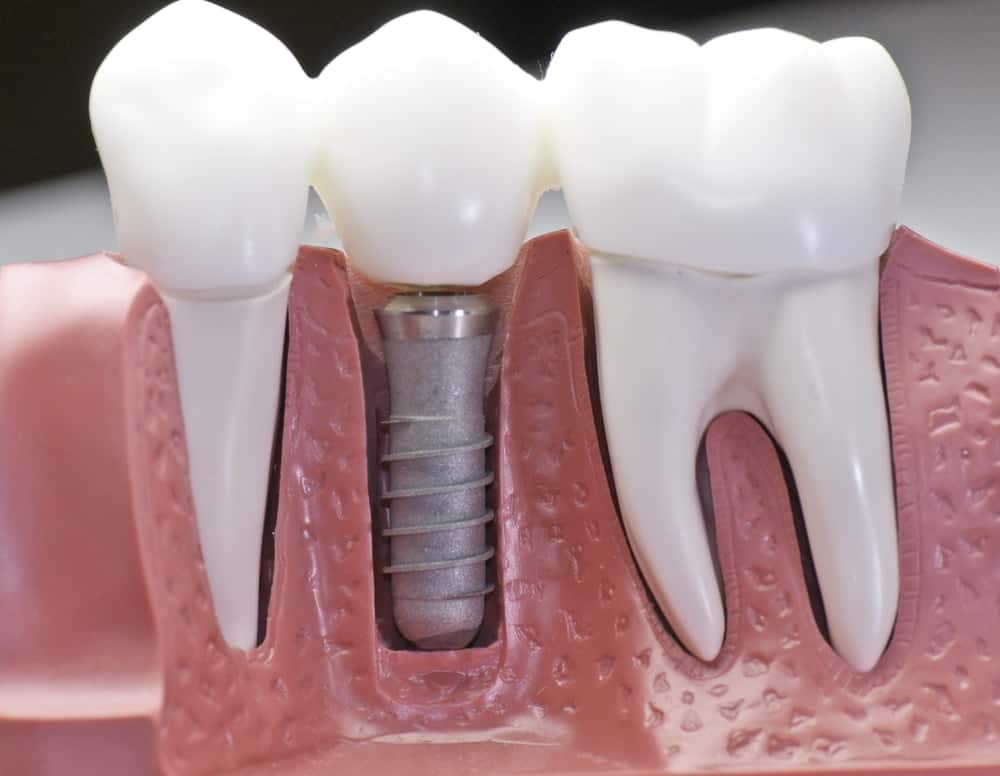 Common Misconceptions About Modern Dental Treatments Folkestone