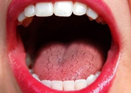 Dry Mouth and Its Role in Tooth Decay Folkestone