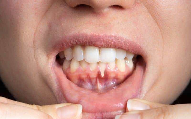 How Can Gum Disease Be Prevented Folkestone?