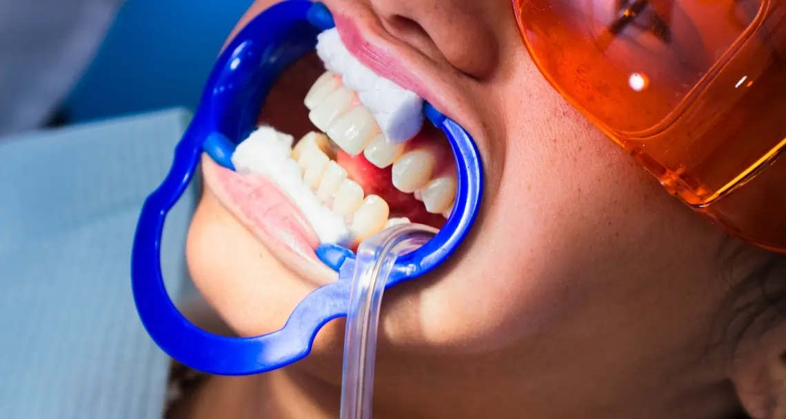 How Teeth Whitening Treatments Actually Work on Your Enamel Folkestone