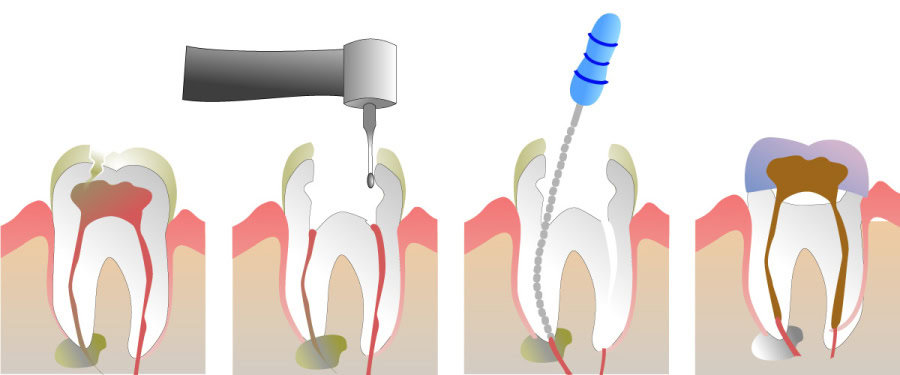 How Do You Properly Care for Your Teeth After a Root Canal Folkestone