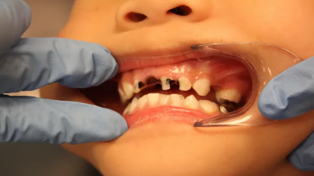Which Foods and Drinks Cause the Most Damage to Young Smiles Folkestone?