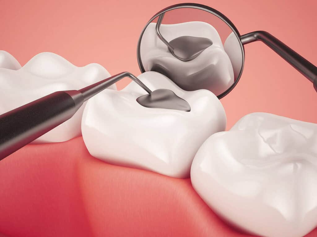 Fighting Cavities and Plaque Buildup Folkestone
