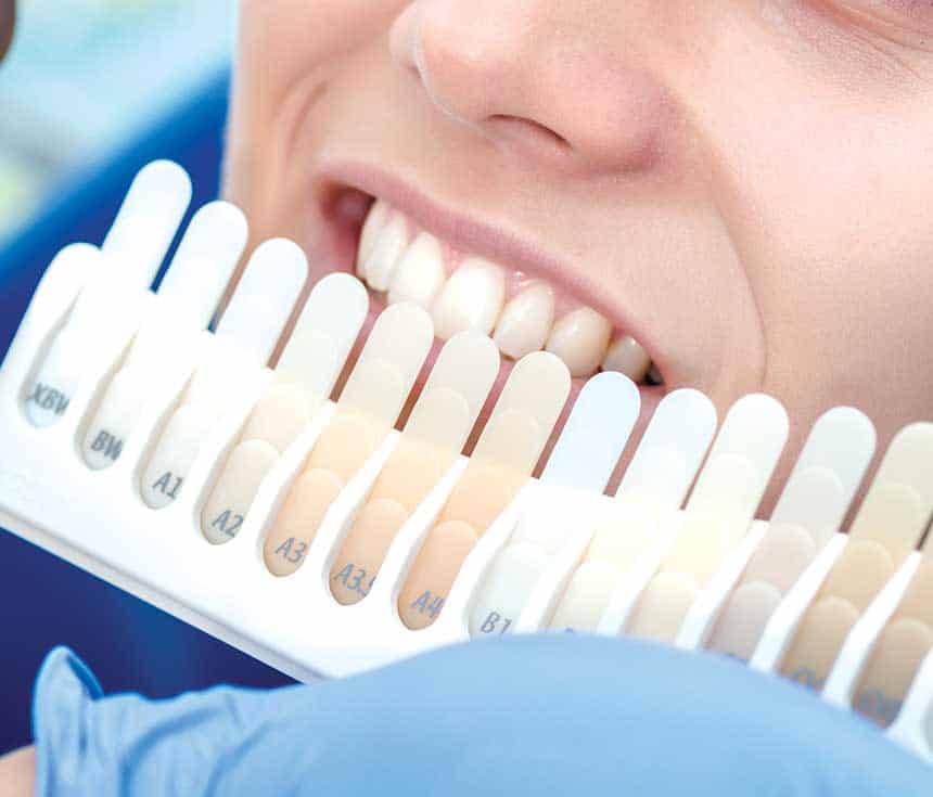 Professional vs At-Home Whitening: What You Need to Know Folkestone