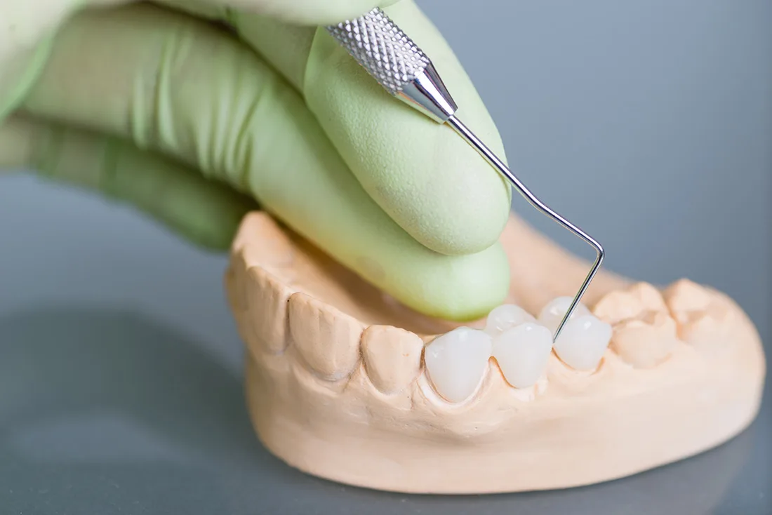 What Are the Different Types of Dental Crowns Available Folkestone?