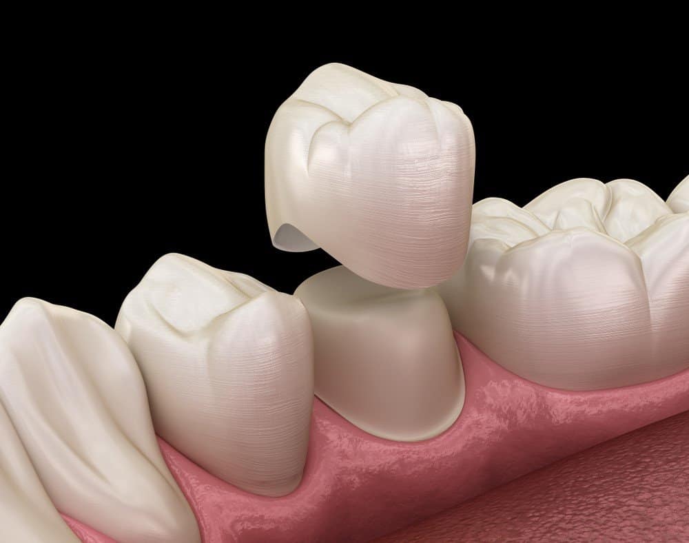 How Can You Prevent Common Dental Crown Problems Folkestone?
