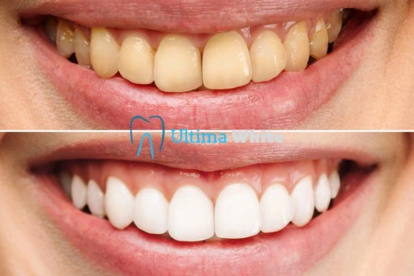 Oral Care Tips for Current and Former Smokers Folkestone