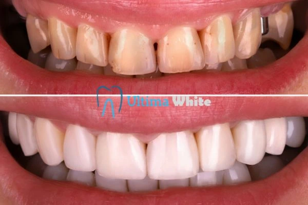 What Makes Instant Teeth Whitening Treatments So Popular Folkestone?