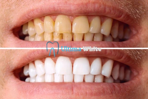 Stained Teeth and Persistent Bad Breath Folkestone